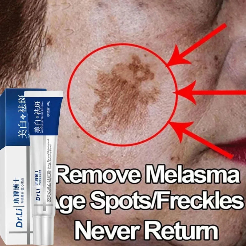 Effective Whitening Freckles Cream Remove Melasma Dark Spots Fade Pigmentation Moisturize Brighten Face Skin Care Product
