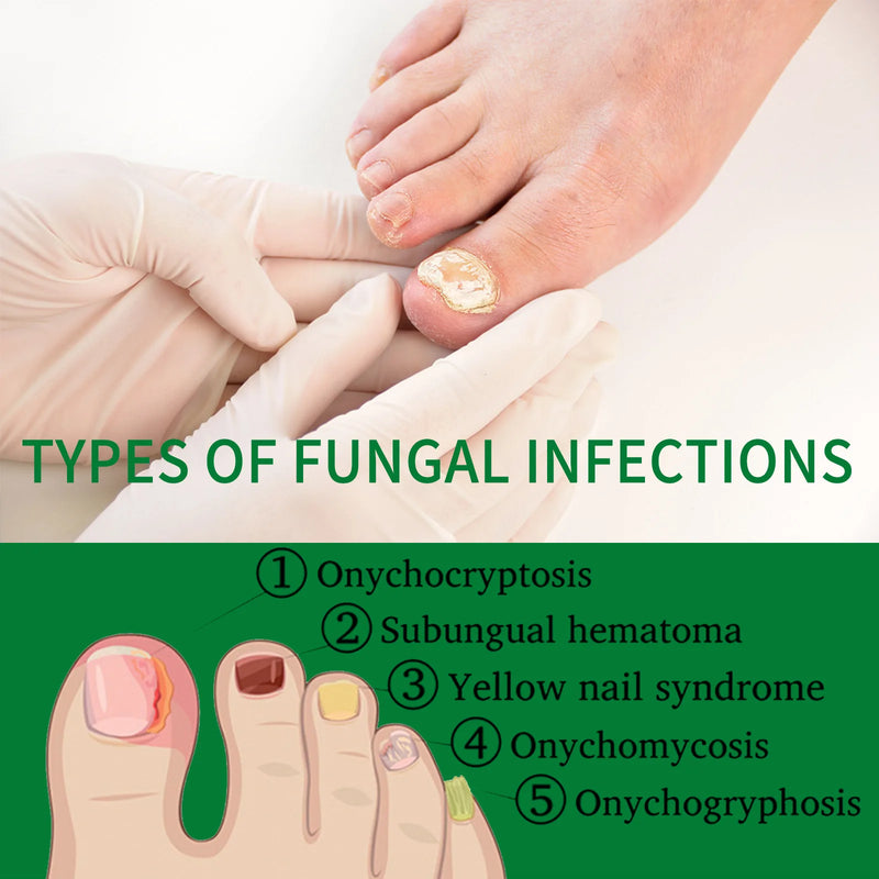 1-5Pcs Nail Fungal Treatment Device 7 Days Repair Oil Foot Toe Essence Anti Infection Paronychia Ginger Onychomycosis Gel Care