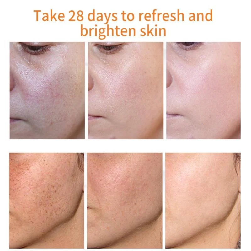 Effective Whiten Freckle Cream Remove Dark Spot Melasma Fade Melanin Anti-Pigmentation Improve Dullness Fast Brighten Face