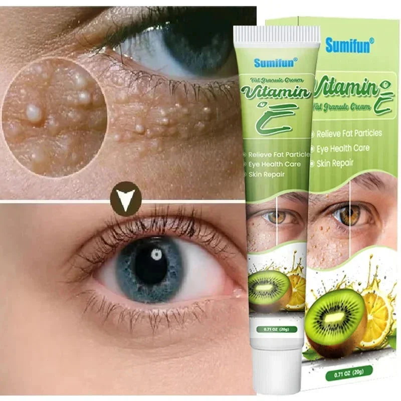 Fat Granules Remover Eye Cream Effective Remove Fat Granules Puffiness Anti-Particles Milia Remover Product Repair Eye Skin Care