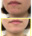 SOME BY MI Bye Bye Blackhead 30 Days Miracle Green Tea Tox Bubble Cleanser Pimple Acne Treatment Blackhead Removal Exfoliating