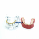 Modelo de implante de reparación de dientes con barra dorada, dentadura postiza, modelo mandibular, modelo de enseñanza Dental