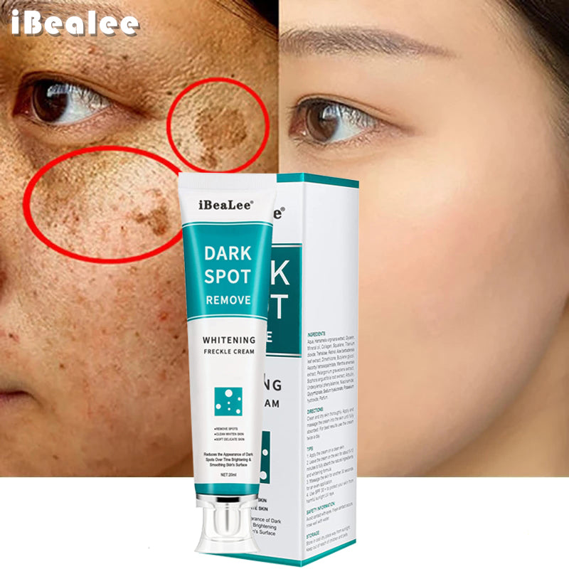 iBeaLee Whitening Freckle Cream Entfernen Sie Melasma-Creme Entfernen Sie dunkle Flecken Melanin-Melasma-Entferner Erhellen Sie die Haut Anti-Aging